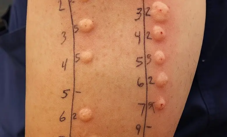 Estas marcas en la piel NO son lo que muchos piensan… 1