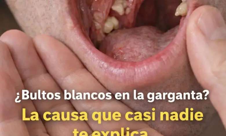 ¿Por qué aparecen bultos blancos en la garganta? 1
