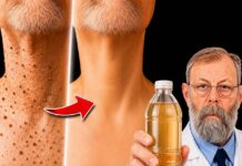 El vinagre eliminará todos los papilomas, queratomas y condilomas.