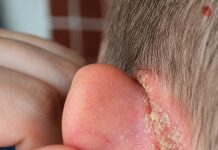 Mancha en la oreja del niño: posibles causas y cuidados en casa hasta la consulta médica
