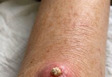 Bulto rosado de crecimiento rápido con tapón duro en el centro: ¿qué podría ser?