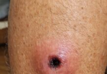 Llaga roja con el centro oscuro y hundido en la piel: qué puede ser y cuándo es una emergencia