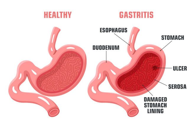 Gastritis: síntomas que nunca debes ignorar 1