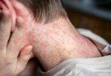 Si tus hijos no están vacunados contra el sarampión, esto es lo que debes hacer HOY mismo