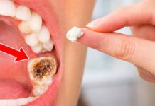 Cómo aliviar temporalmente el dolor dental con medidas sencillas en casa.