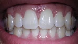Desbloquea una sonrisa radiante: 5 remedios naturales para curar las caries y transformar tus dientes 1