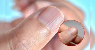 Tener las uñas con rayas: lo que tu cuerpo podría estar tratando de decirte 1